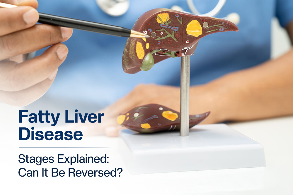 Can Fatty Liver Disease Be Reversed? Here’s What Doctors Recommend